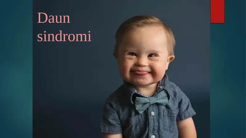 Daunsindromi 1