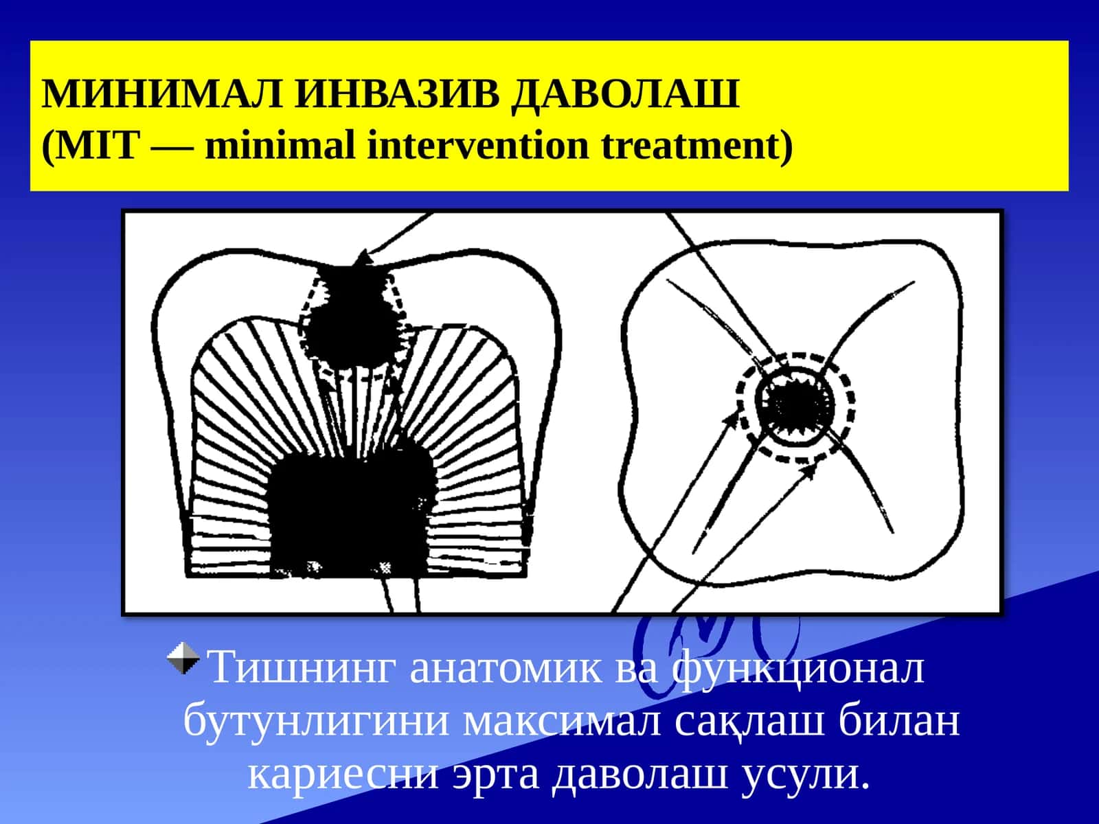 МИНИМАЛИНВАЗИВ ДАВОЛАШ(MIT—minimalinterventiontreatment) 1