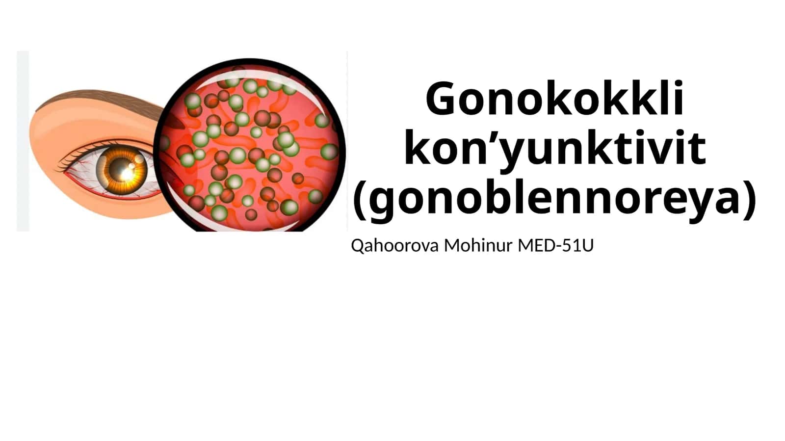 Gonokokkli kon’yunktivit(gonoblennoreya) 1