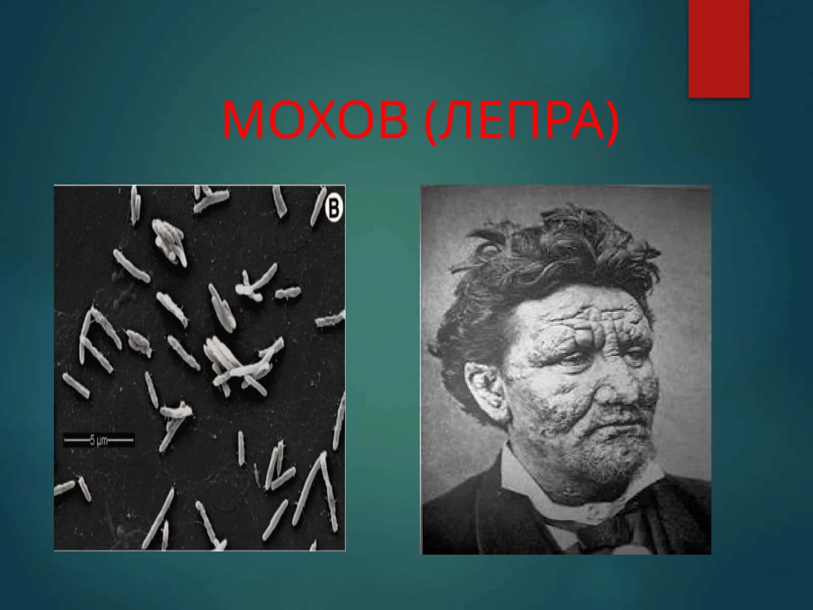 МОХОВ (ЛЕПРА) 1