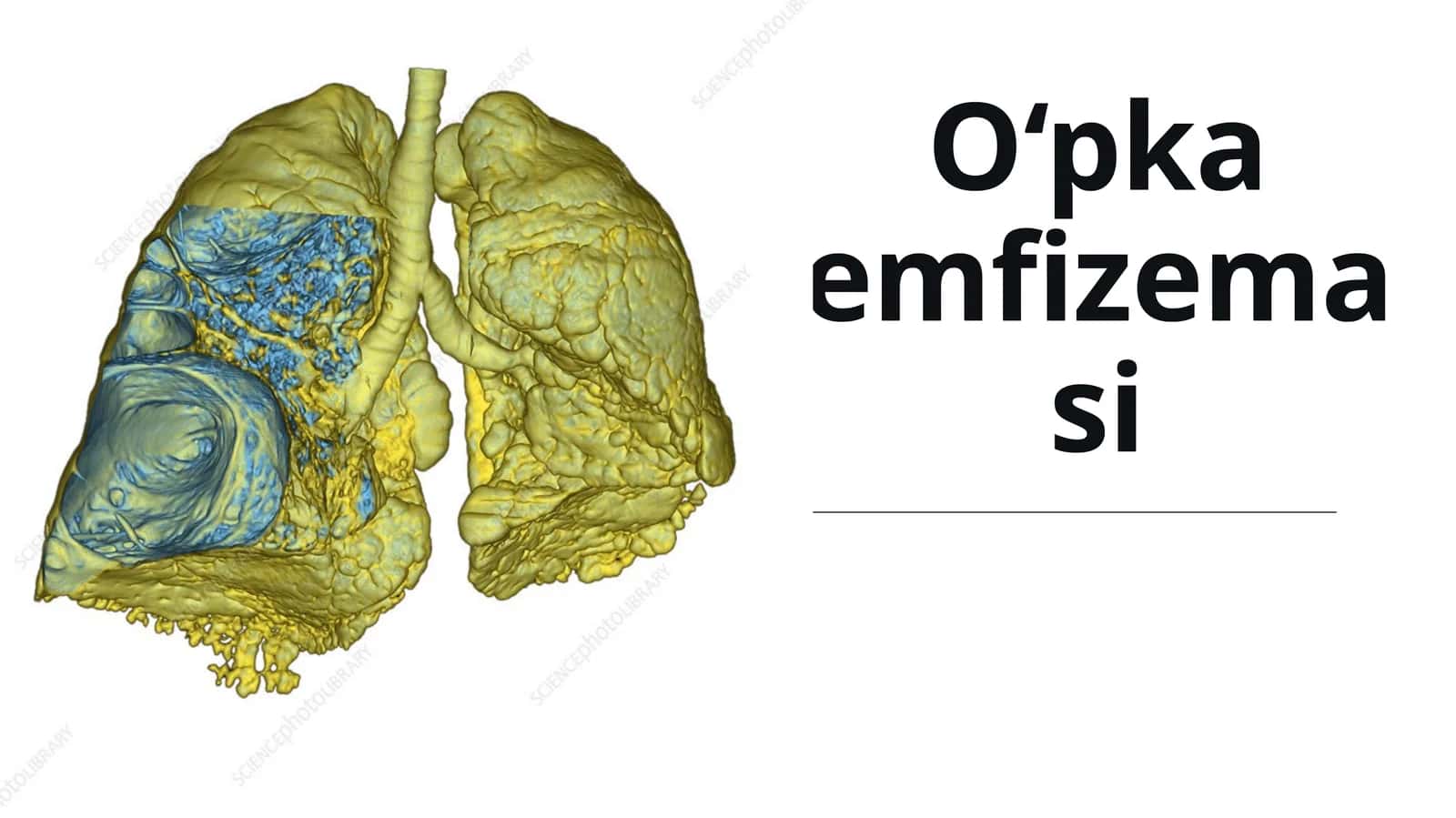 O‘pka emfizemasi 1