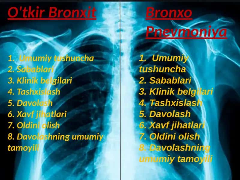 O'tkir Bronxit.  Bronxopnevmoniya 1