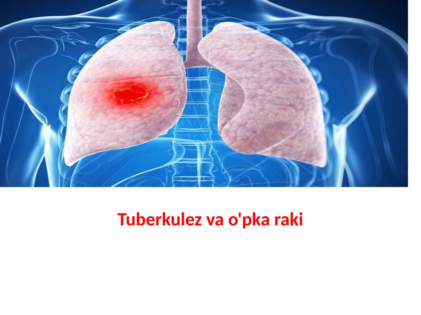Tuberkulezvao'pkaraki 1