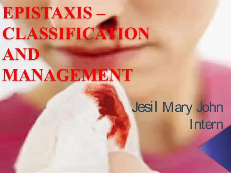 EPISTAXIS – CLASSIFICATION AND MANAGEMENT 1