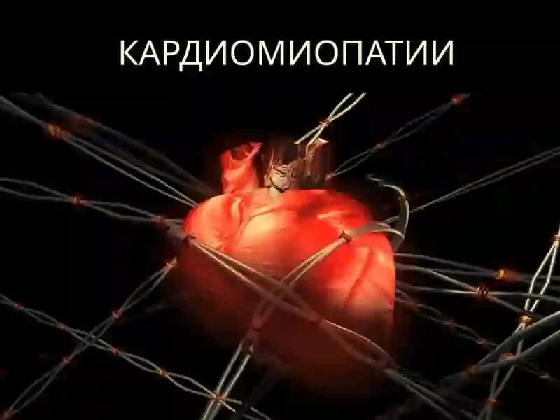 КАРДИОМИОПАТИИ