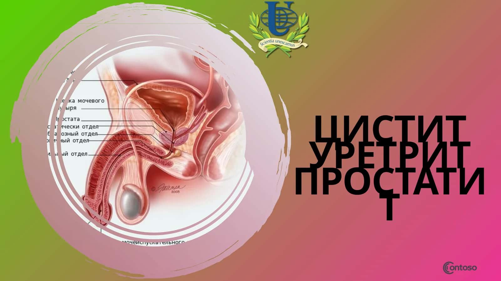 Цистит уретрит 1