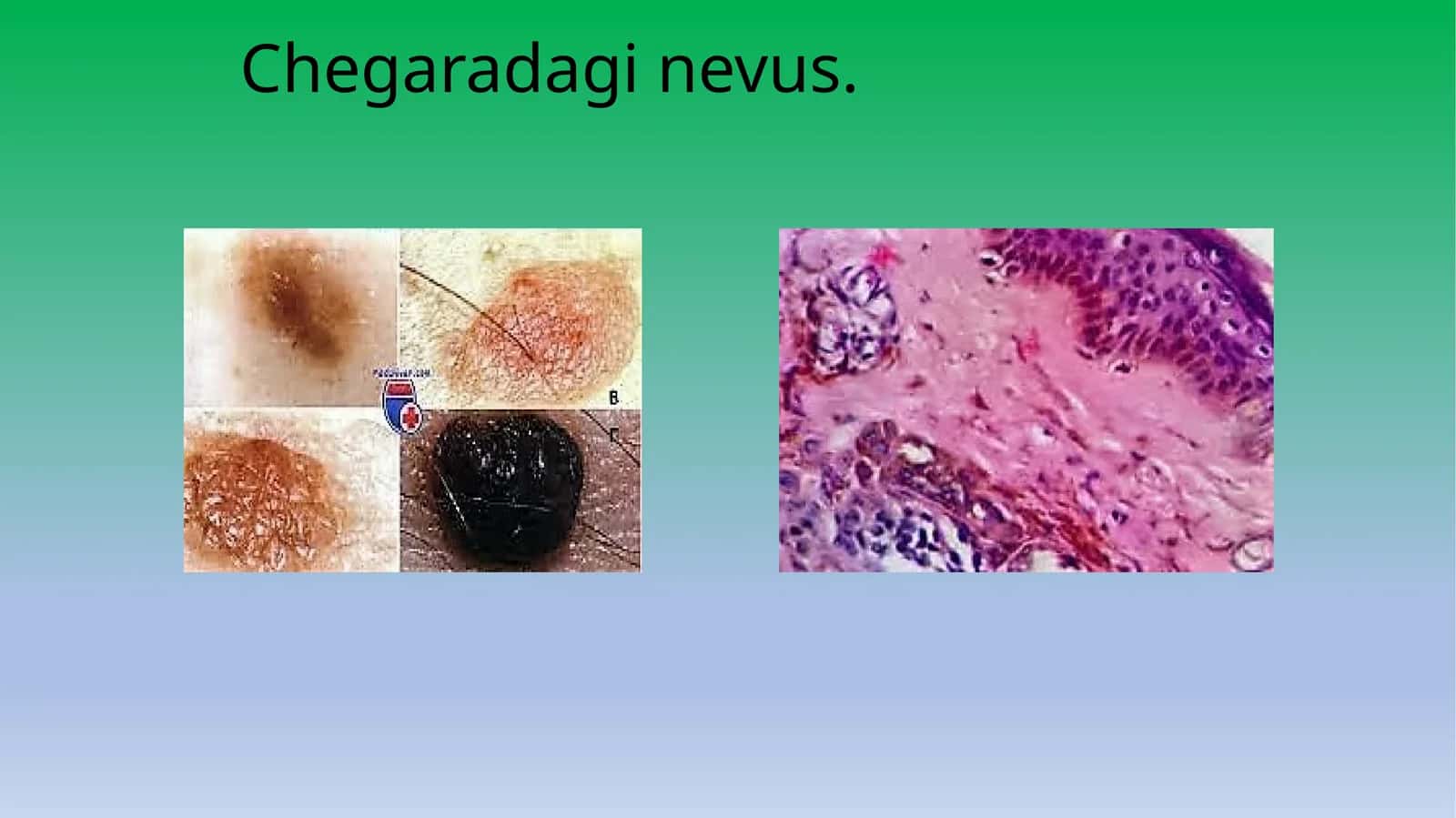 Chegaradagi nevus 1