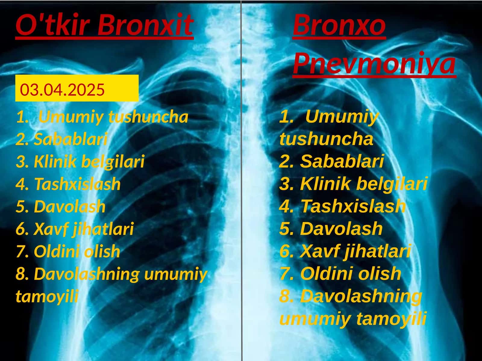 O'tkirBronxit 1