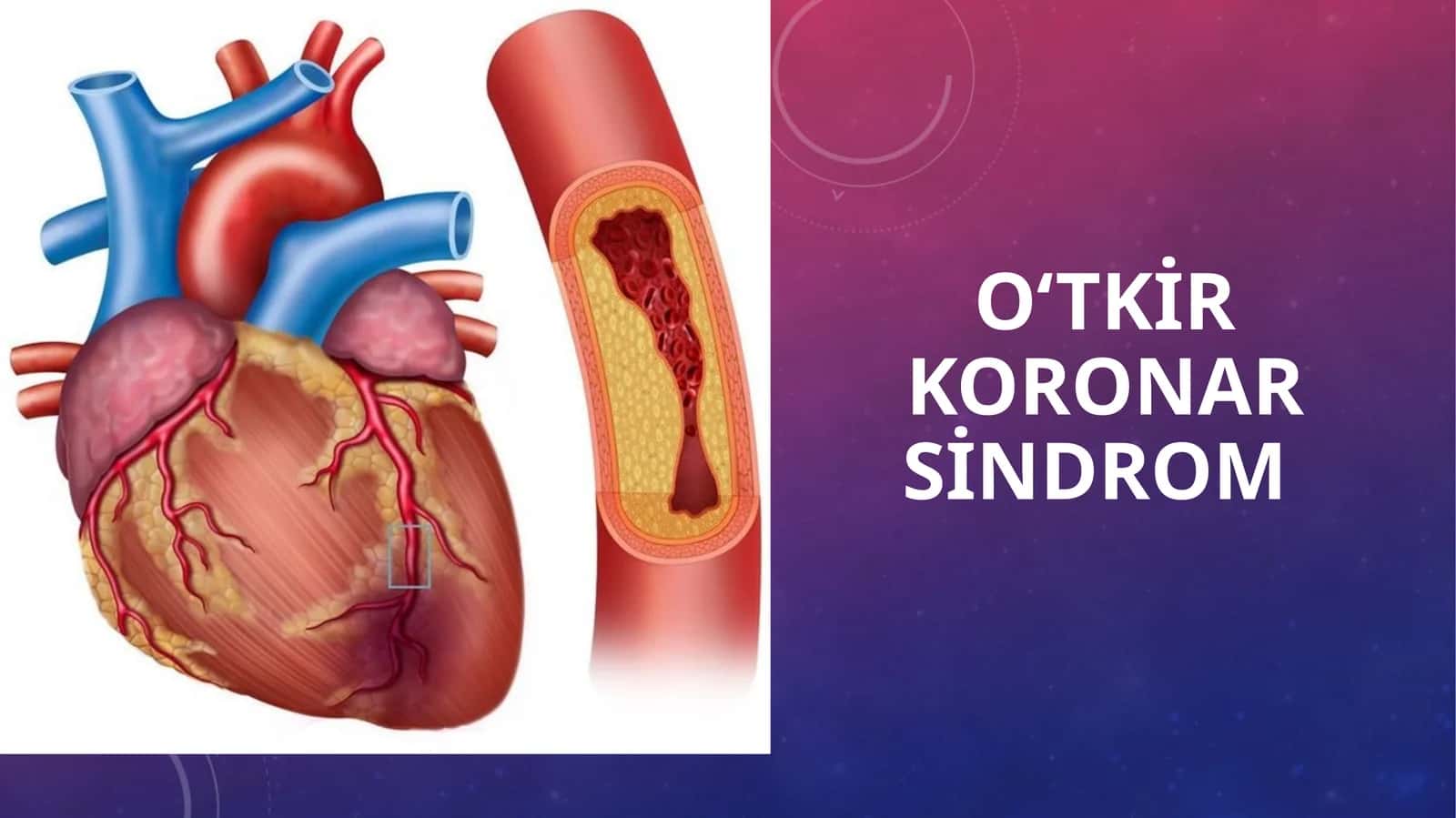 O‘tkir koronar sindrom 1