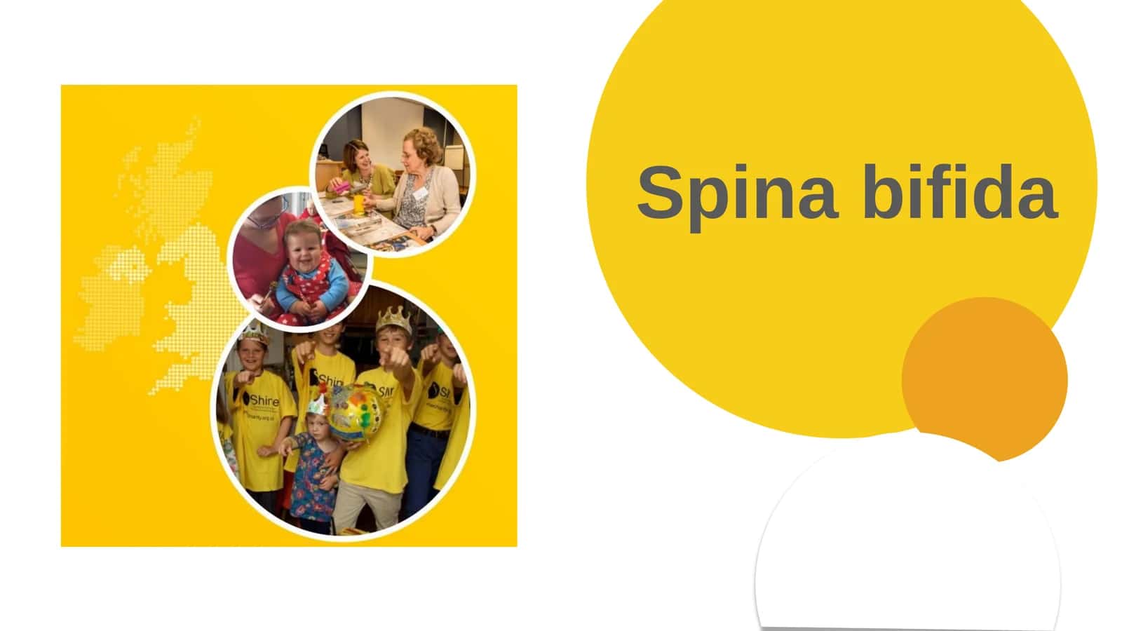 Spina bifida 1