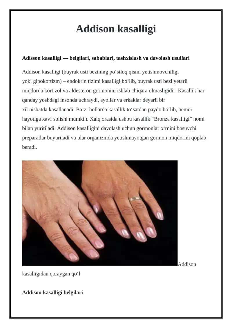 Addison kasalligi 1