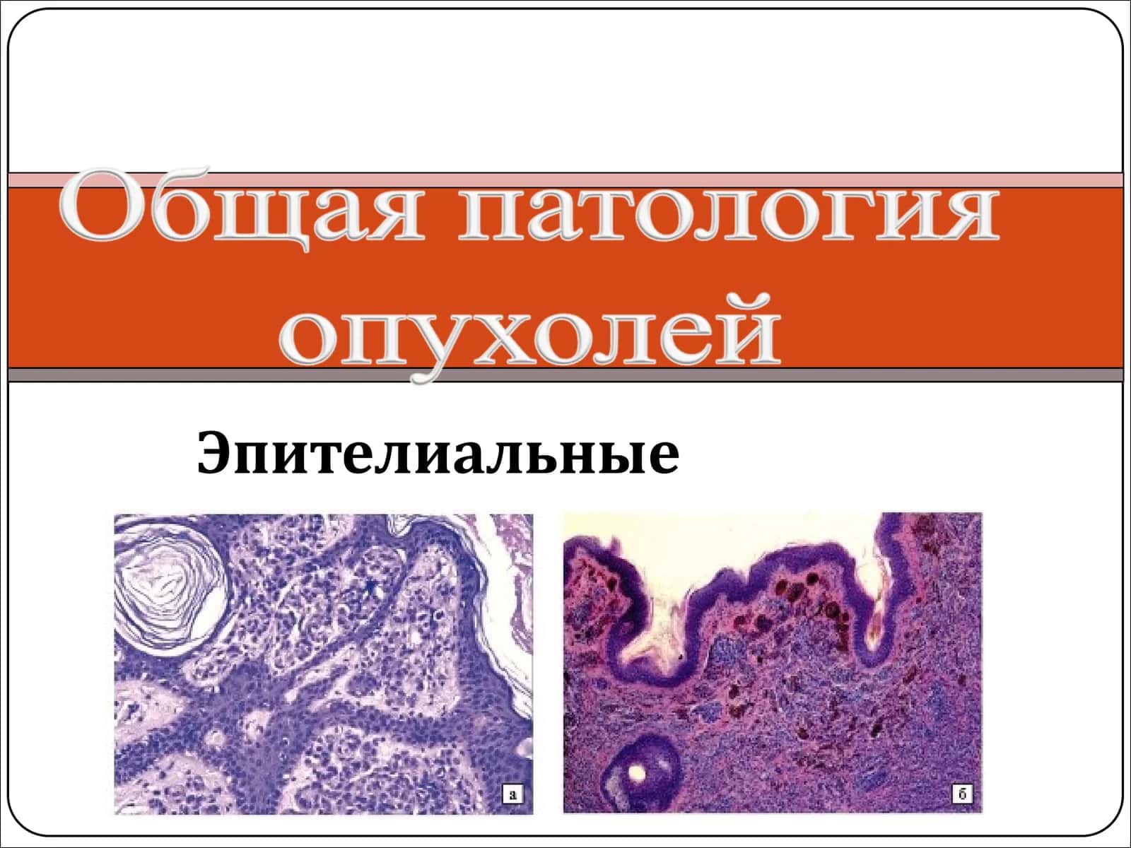 Эпителиальные опухоли 1