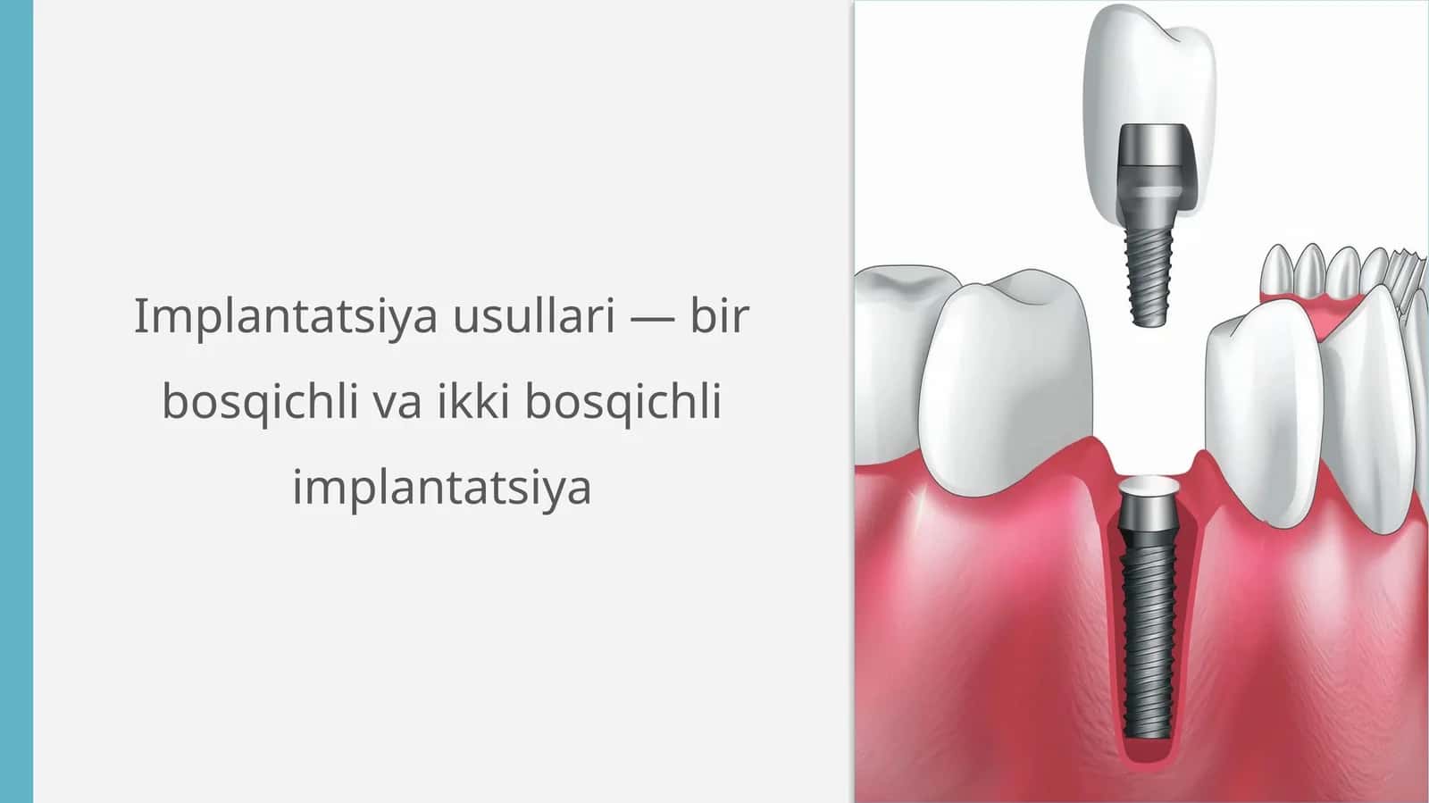 Implantatsiya usullari 1