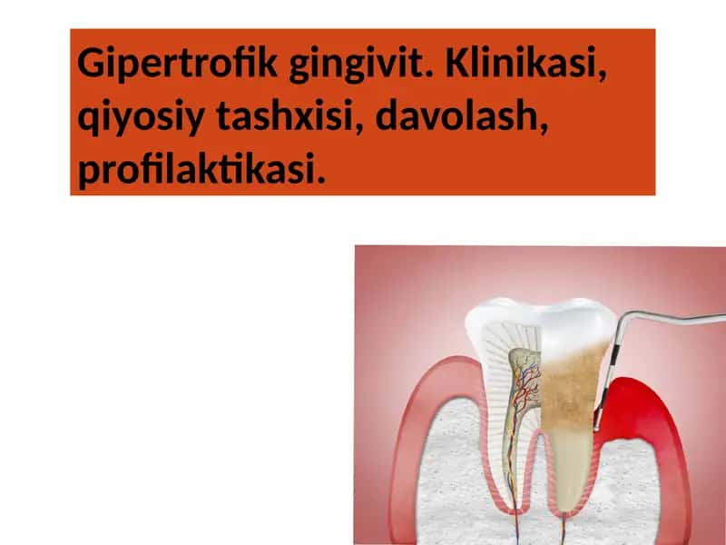 Gipertrofik gingivit 1