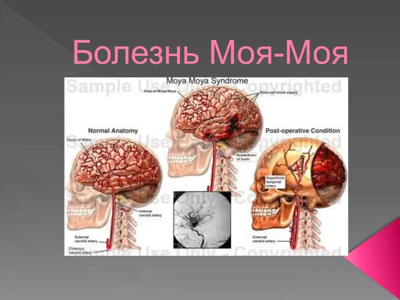 Болезнь Моя-Моя 1