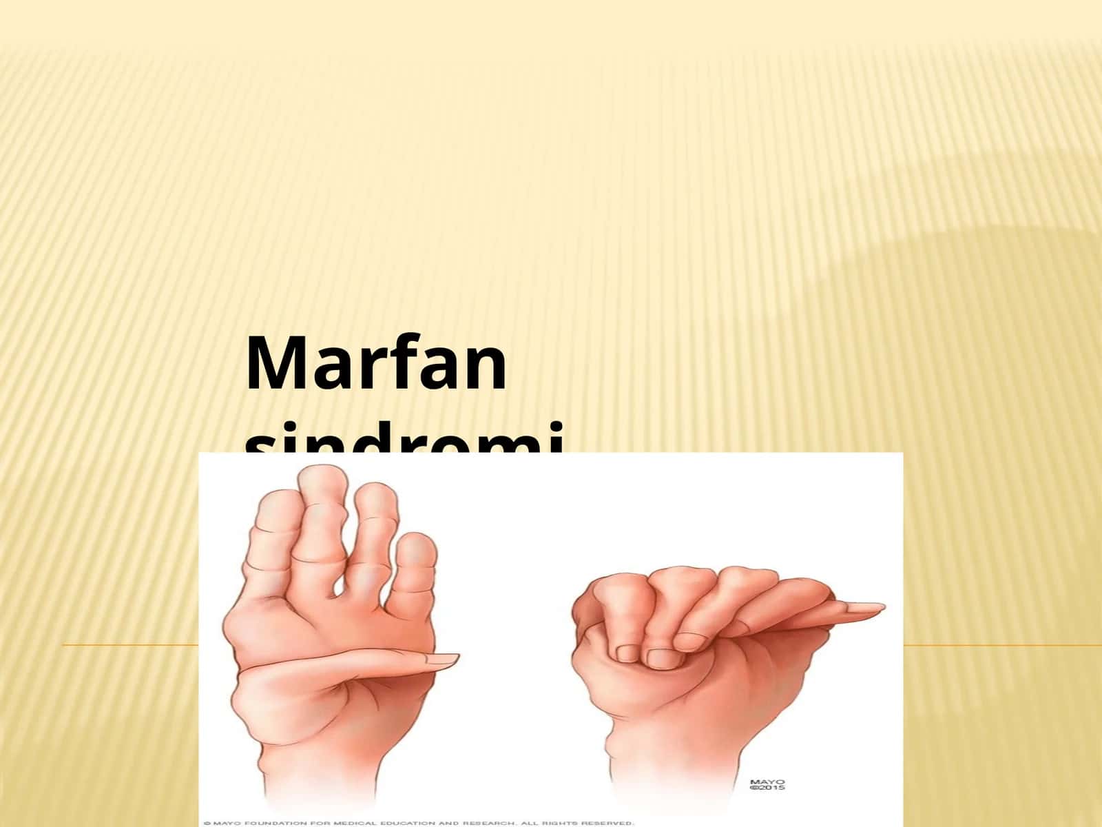 Marfan sindromi 1
