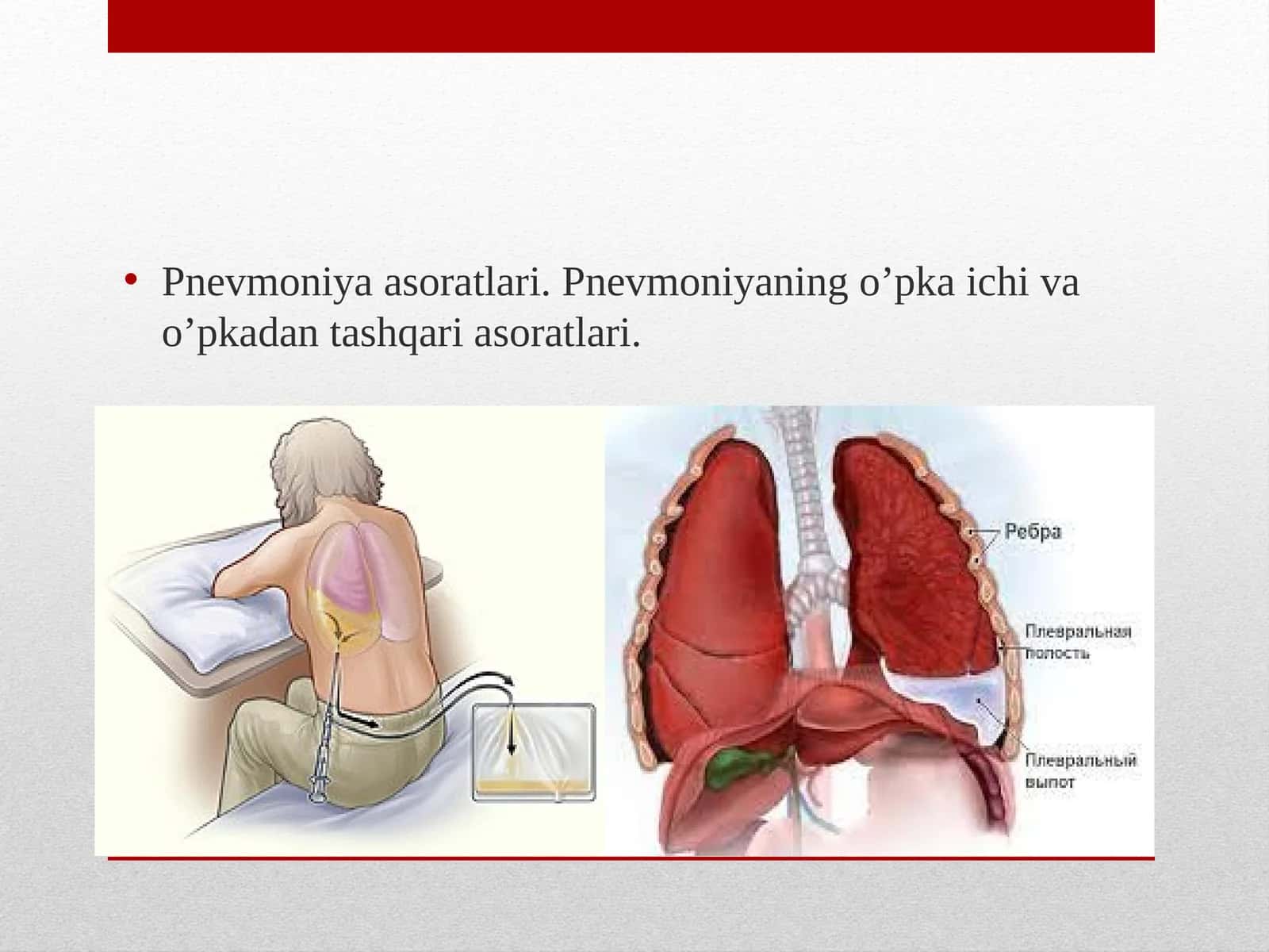 Pnevmoniya asoratlari 1