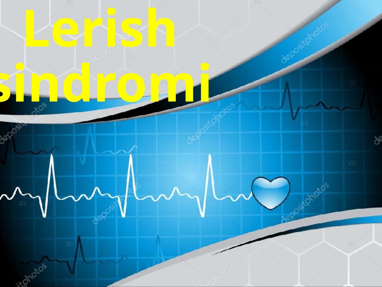 Lerishsindromi 1
