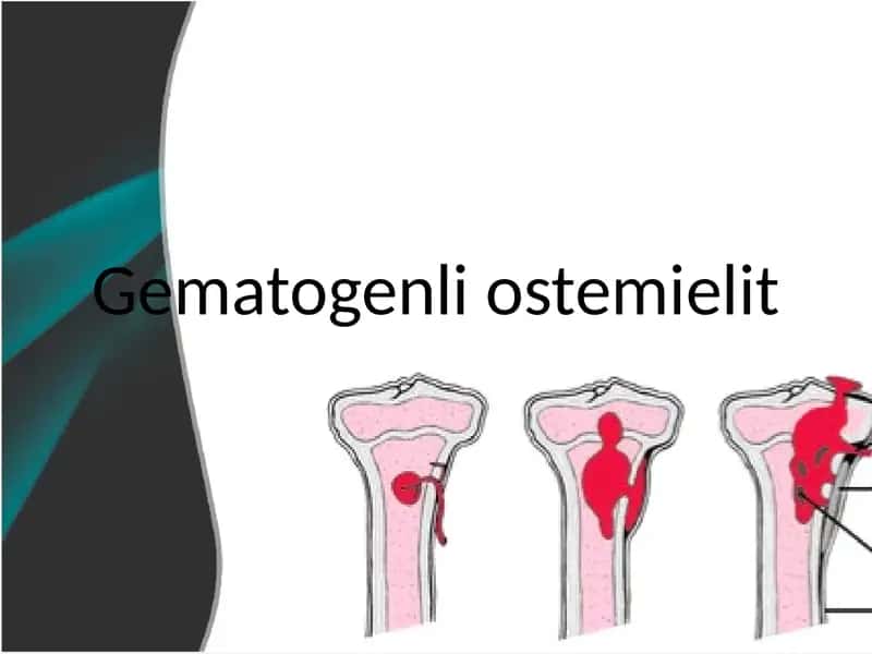 Gematogenli osteomiyelit 1