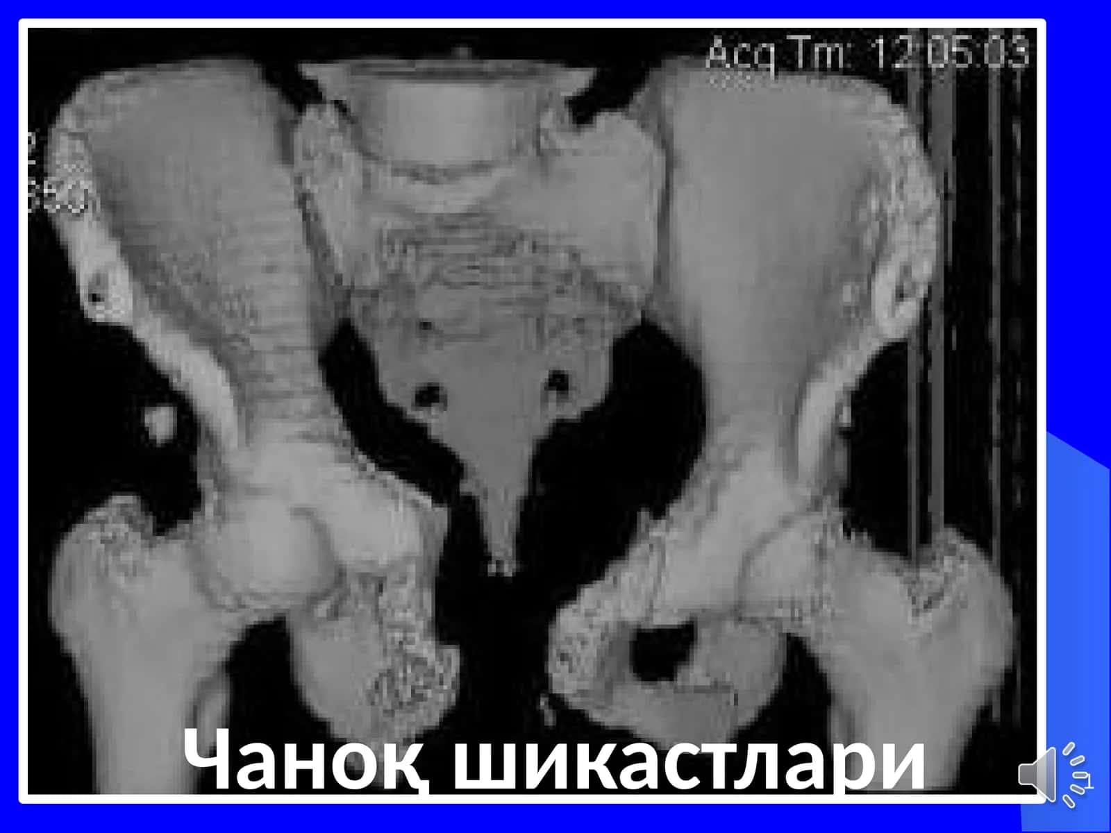 Чаноқ шикастлари 1