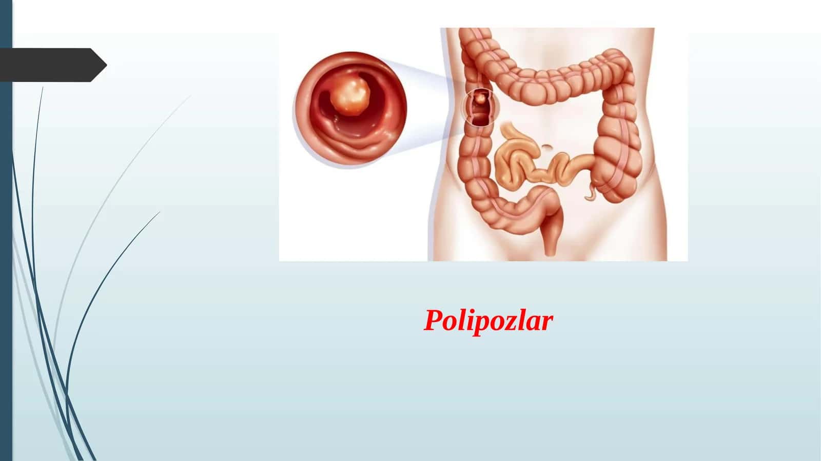 Polipozlar 1