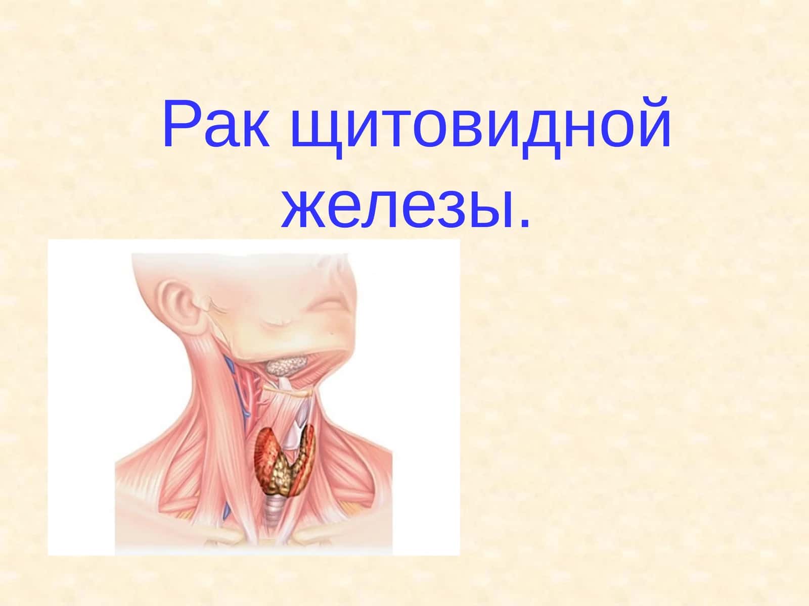 Рак щитовидной железы 1