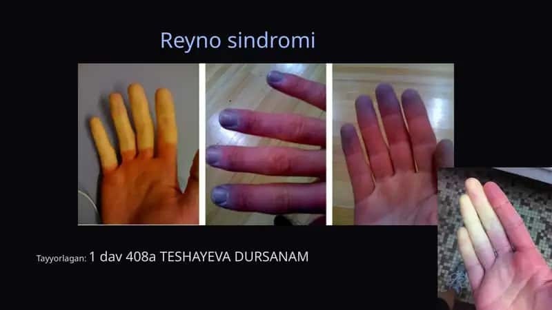Reyno sindromi 1