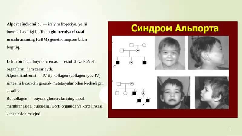 Alport sindromi pptx 1