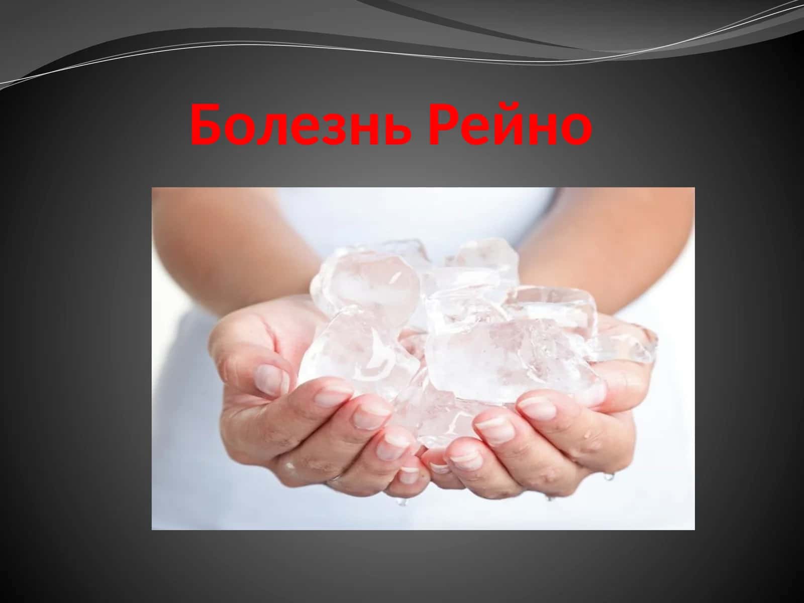 Болезнь Рейно 1
