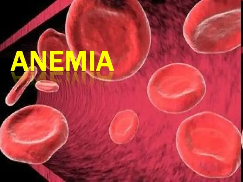 Blood smear analysis for sickle-cell anemia 1