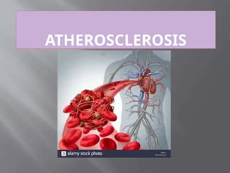 Atherosclerosis 1