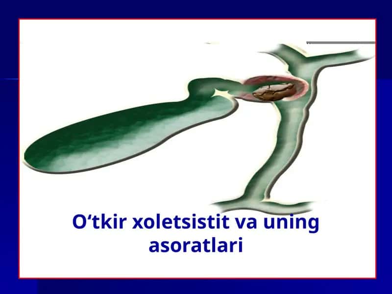 O‘tkir xoletsistit va uning asoratlari 1