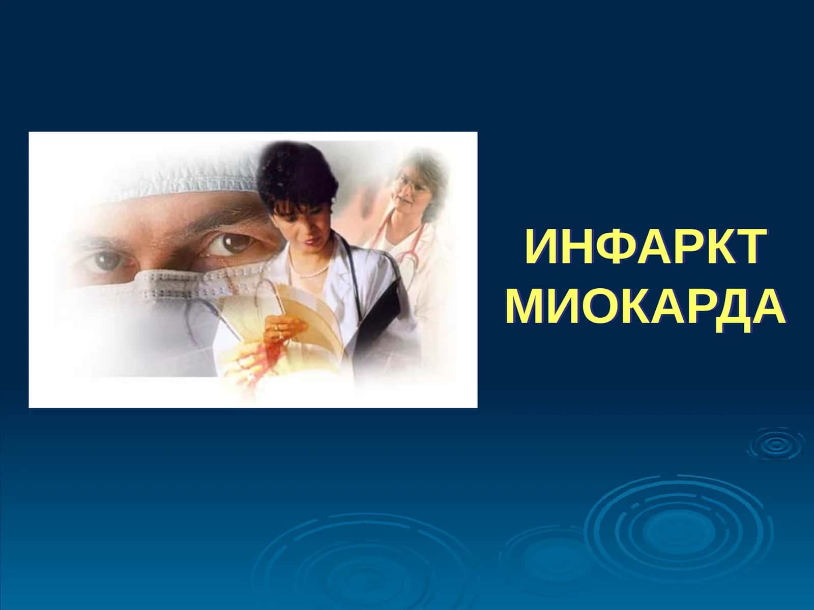 ИНФАРКТ МИОКАРДА 1