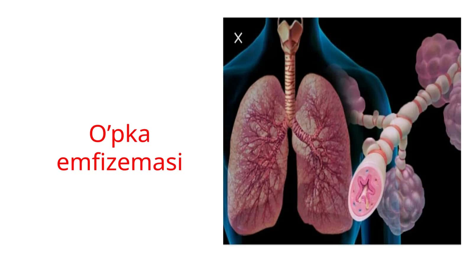 O’pka emfizemasi 1