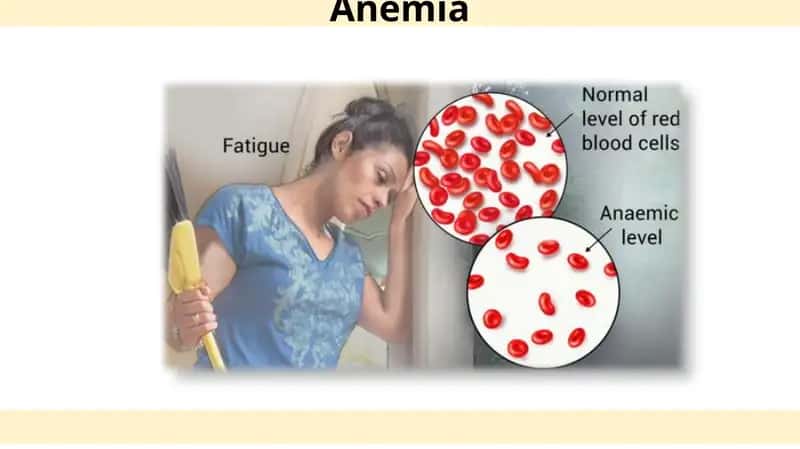 Anemia 1