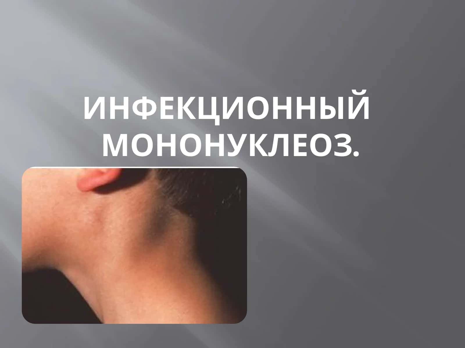 Инфекционный мононуклеоз 1