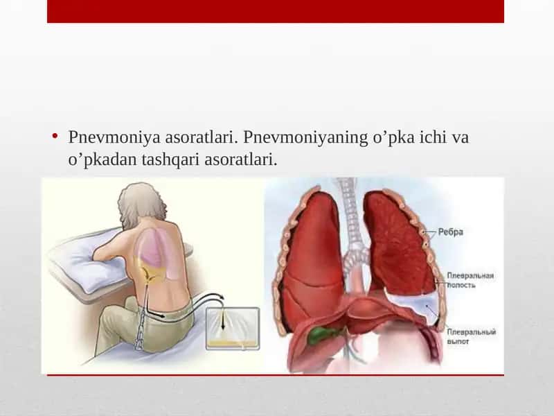 Pnevmoniya Asoratlari 1