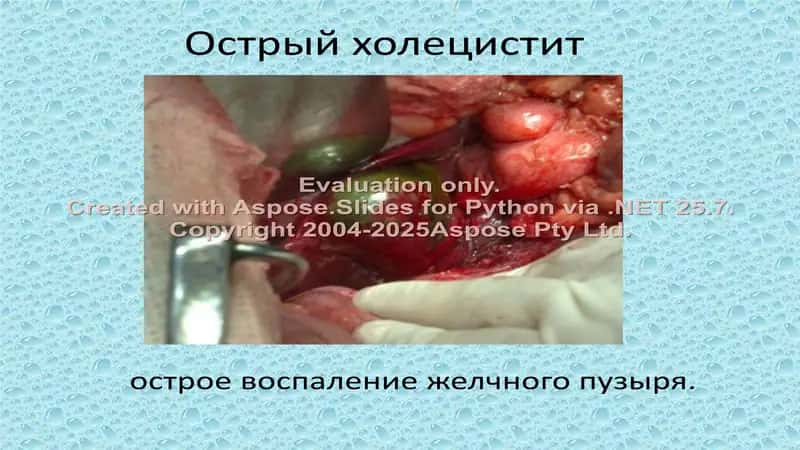 Острый холецистит 1