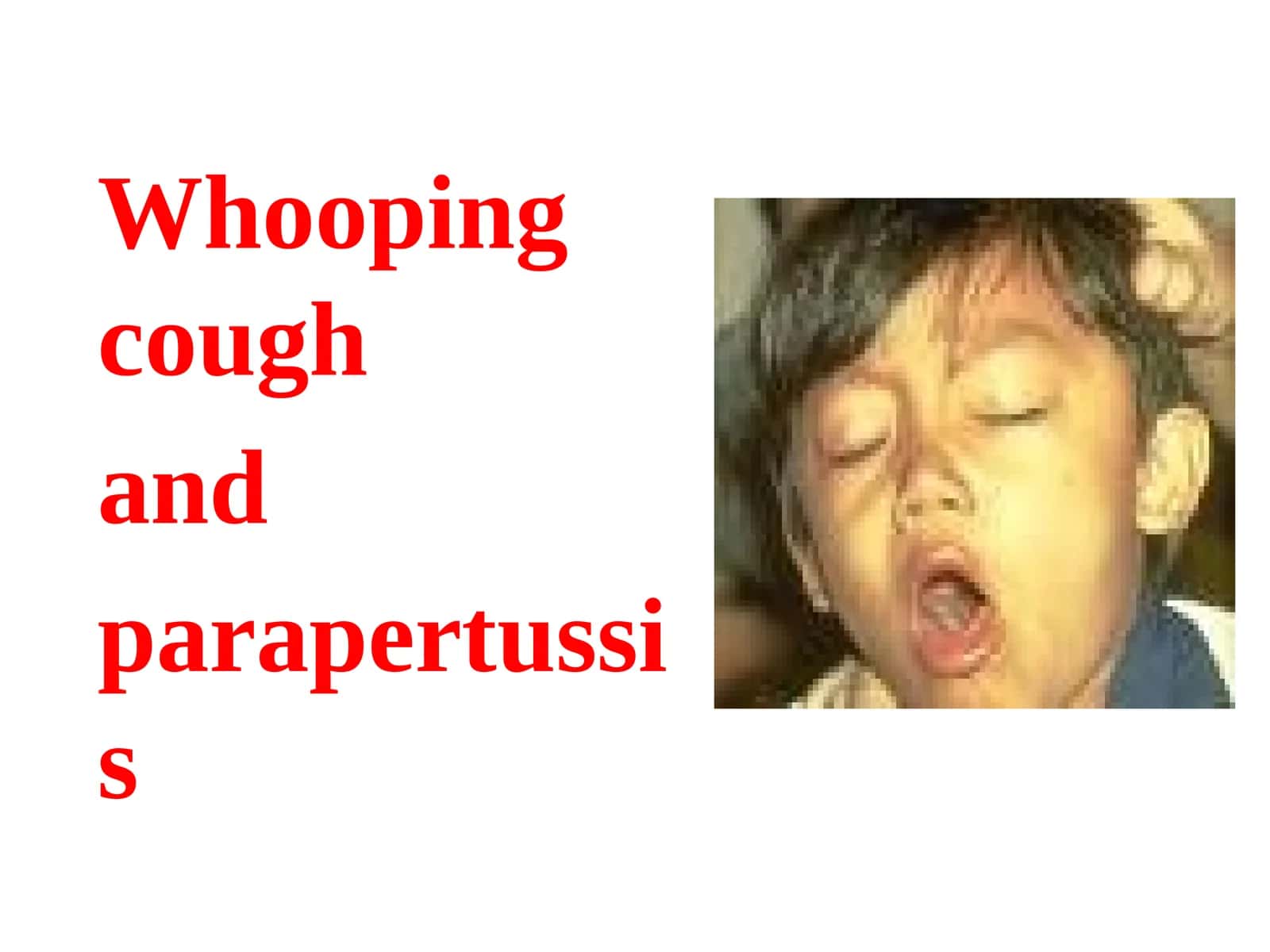 Whooping cough and parapertussis 1