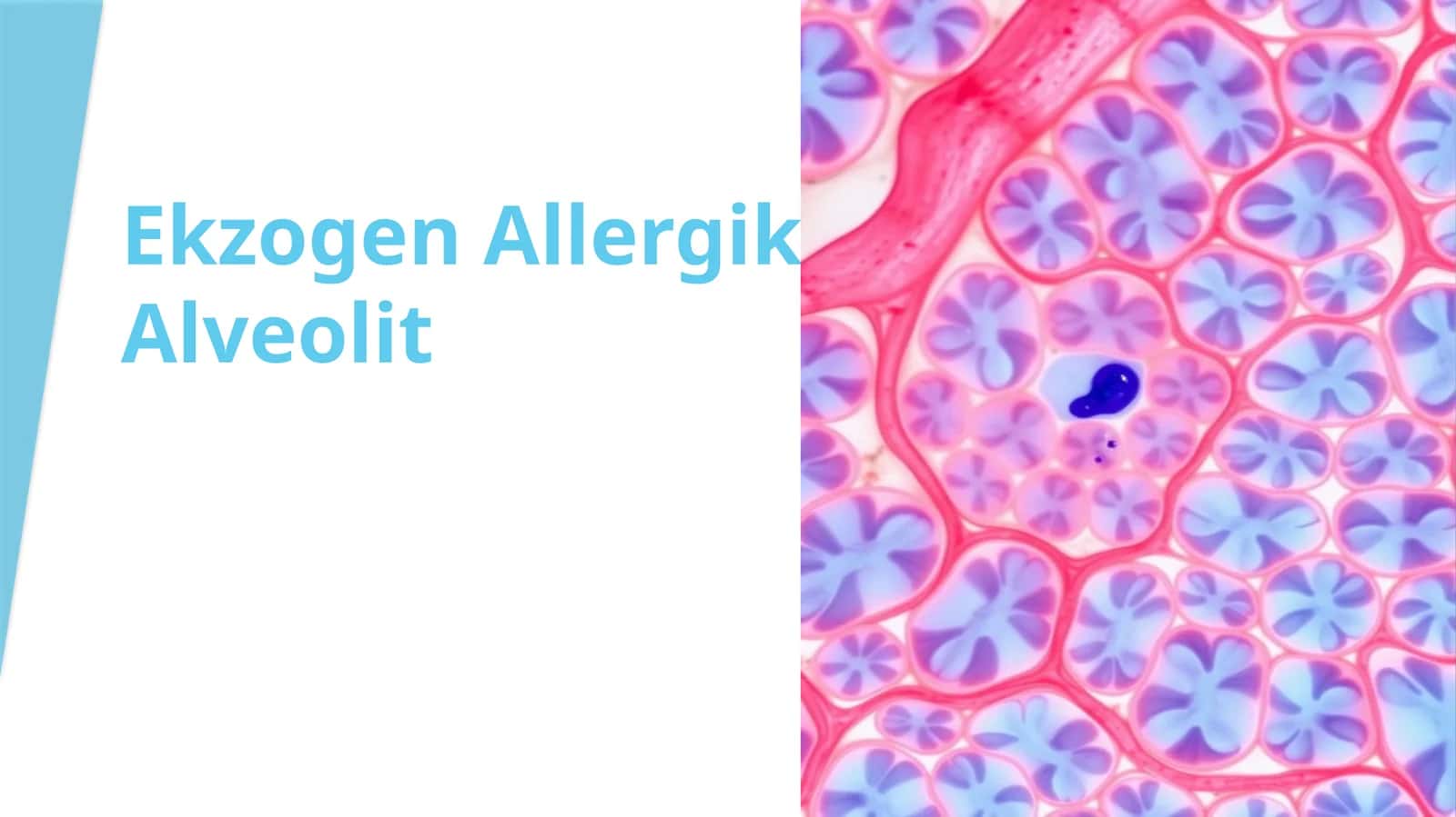 Ekzogen Allergik Alveolit 1
