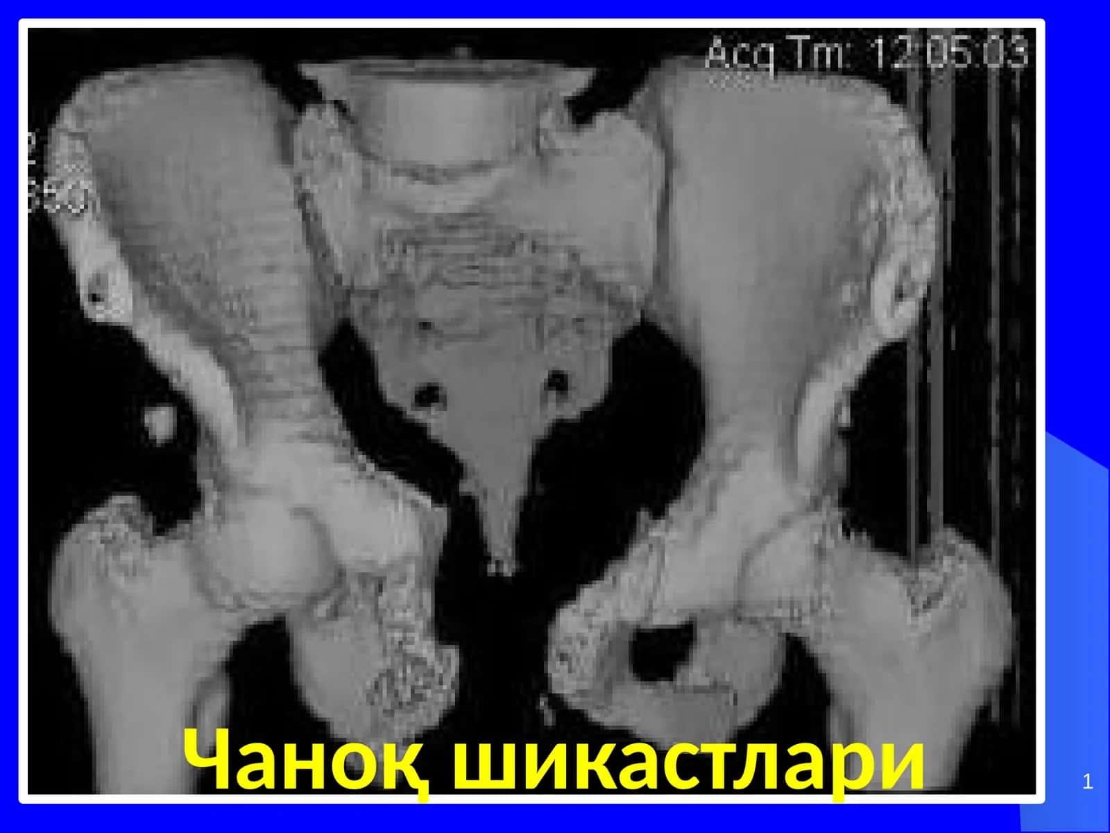 Чаноқ шикастлари 1