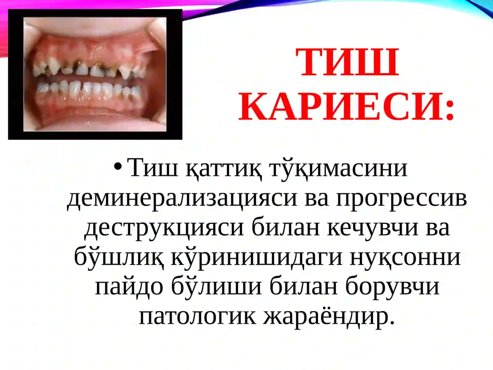 Тиш кариеси: қийосий ташхиси 2