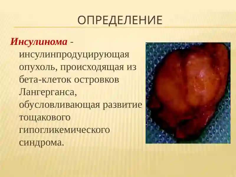 INSULINOMA 2