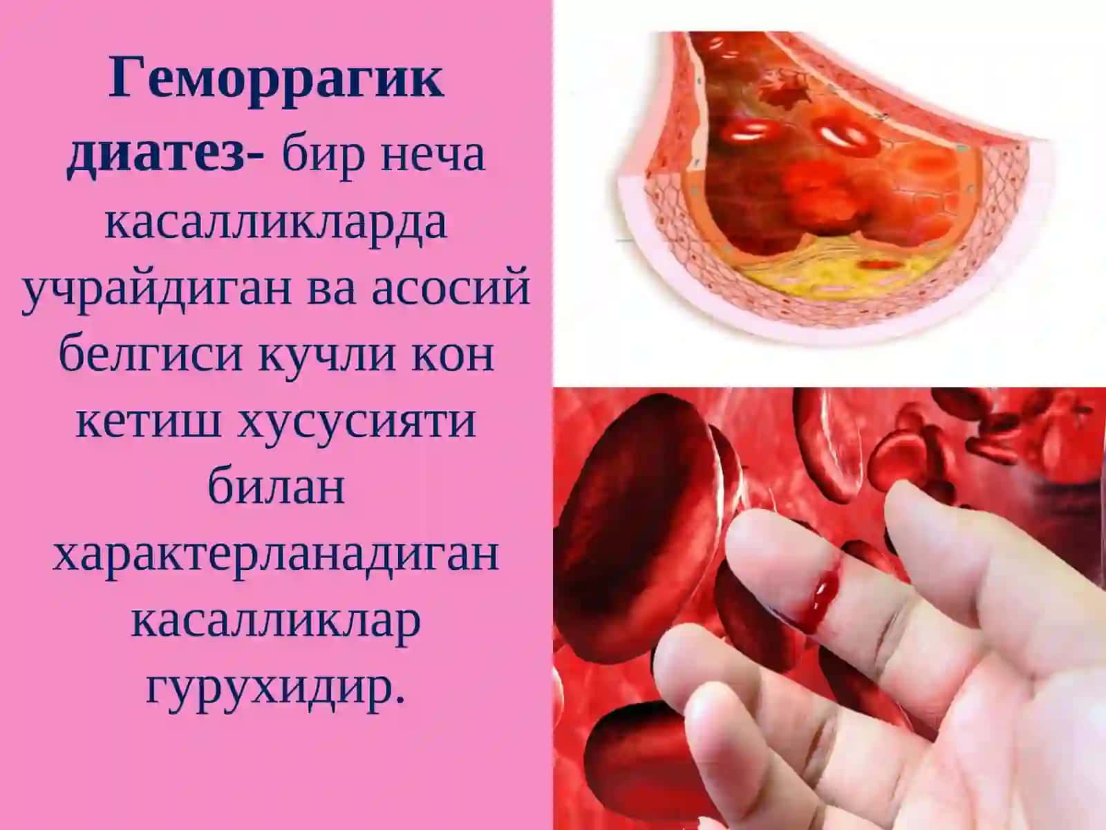 Геморрагик диатез 2