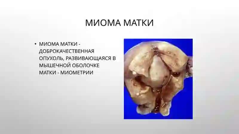 Миома матки 2