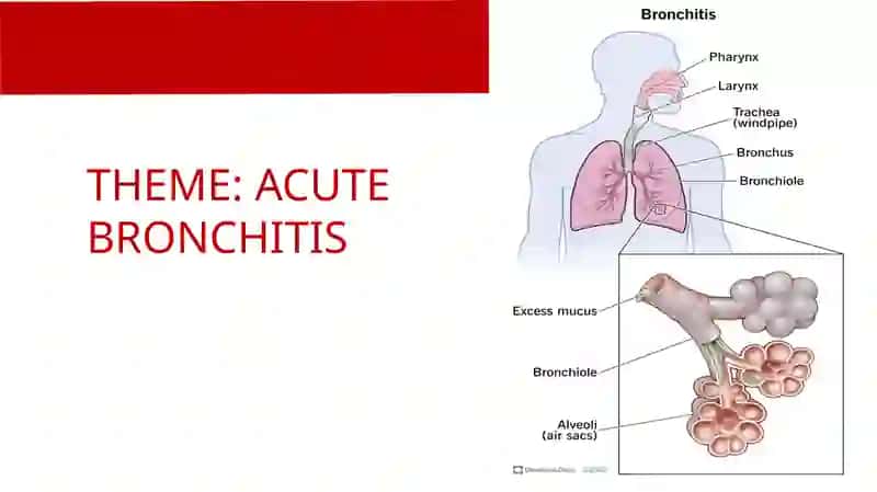 ACUTE BRONCHITIS 2