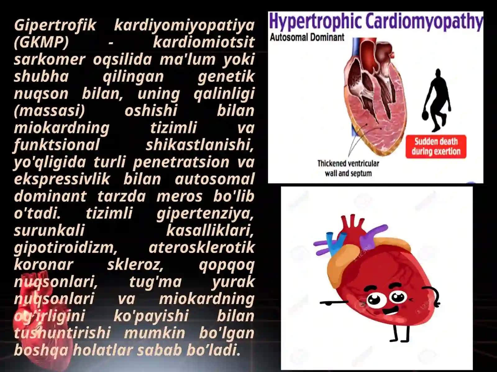 Gipertrofik kardiomiopatiyalar. 2