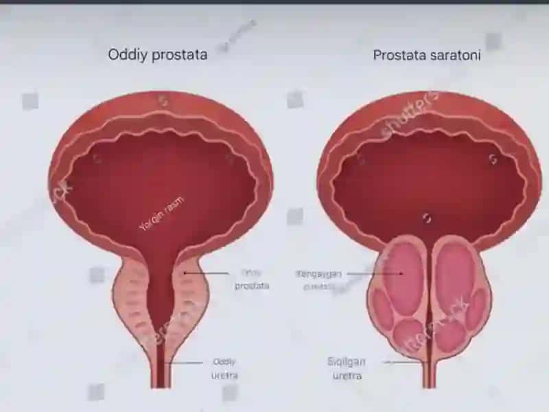 Prostatabezio’smalari 2