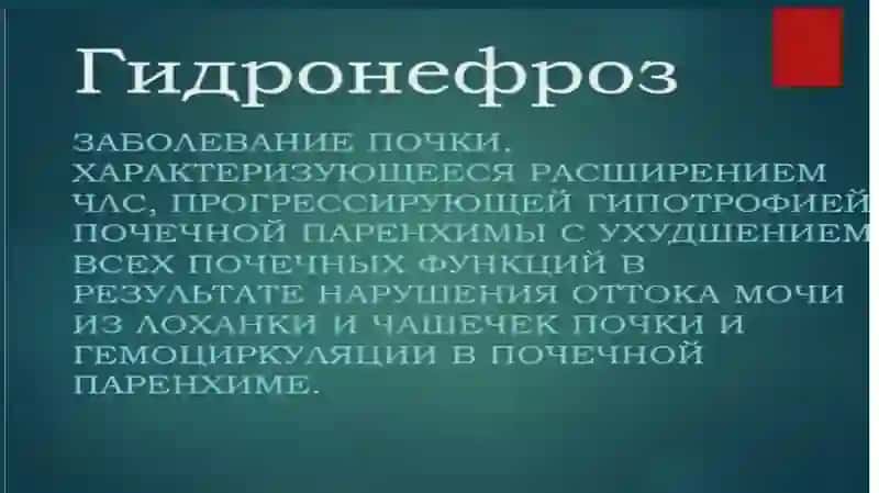 Гидронефроз 2