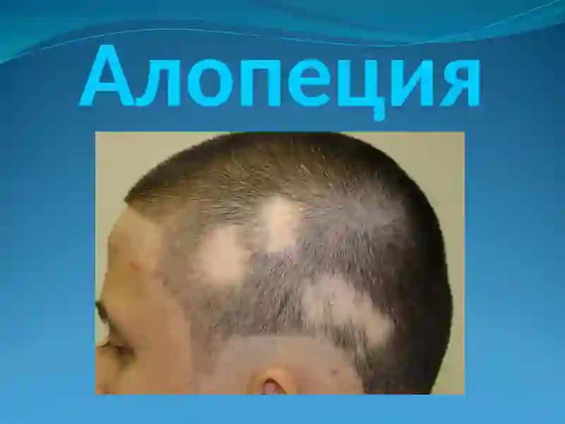 Алопеция 2